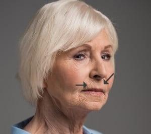 lipstick lines botox dermal filler smokers line lip wrinkles