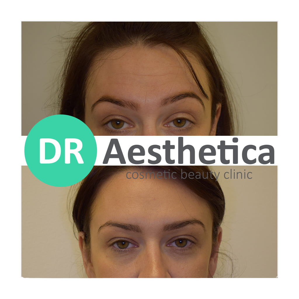Forehead botox result 9