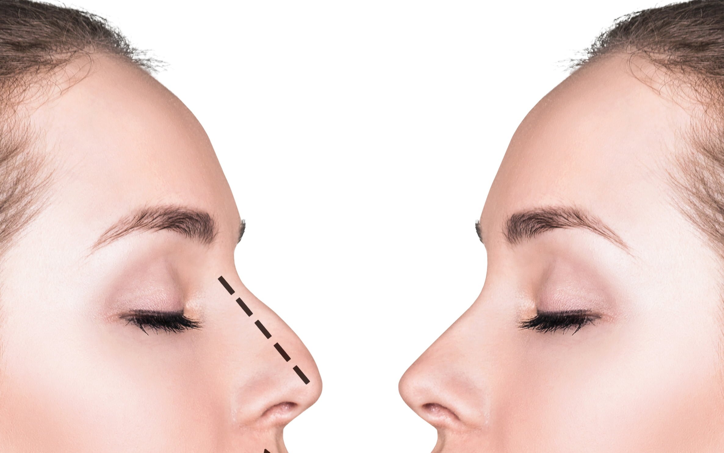 Bump On Nose Treatment Without Surgery Dr Aesthetica bump on nose treatment without surgery