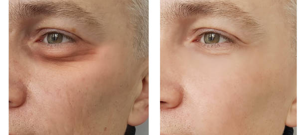 filling tear troughs with under eye fillers