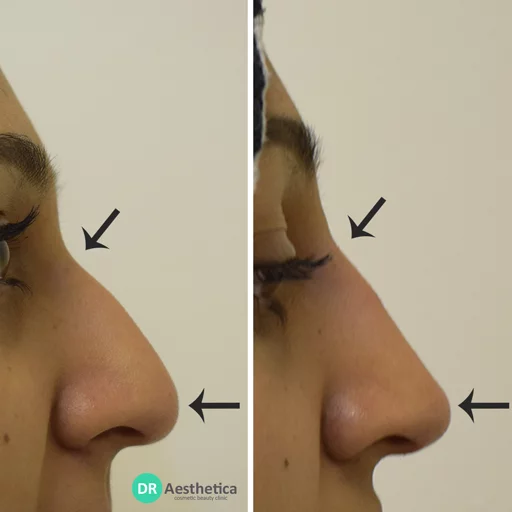 Hooked nose rhinoplasty non surgical