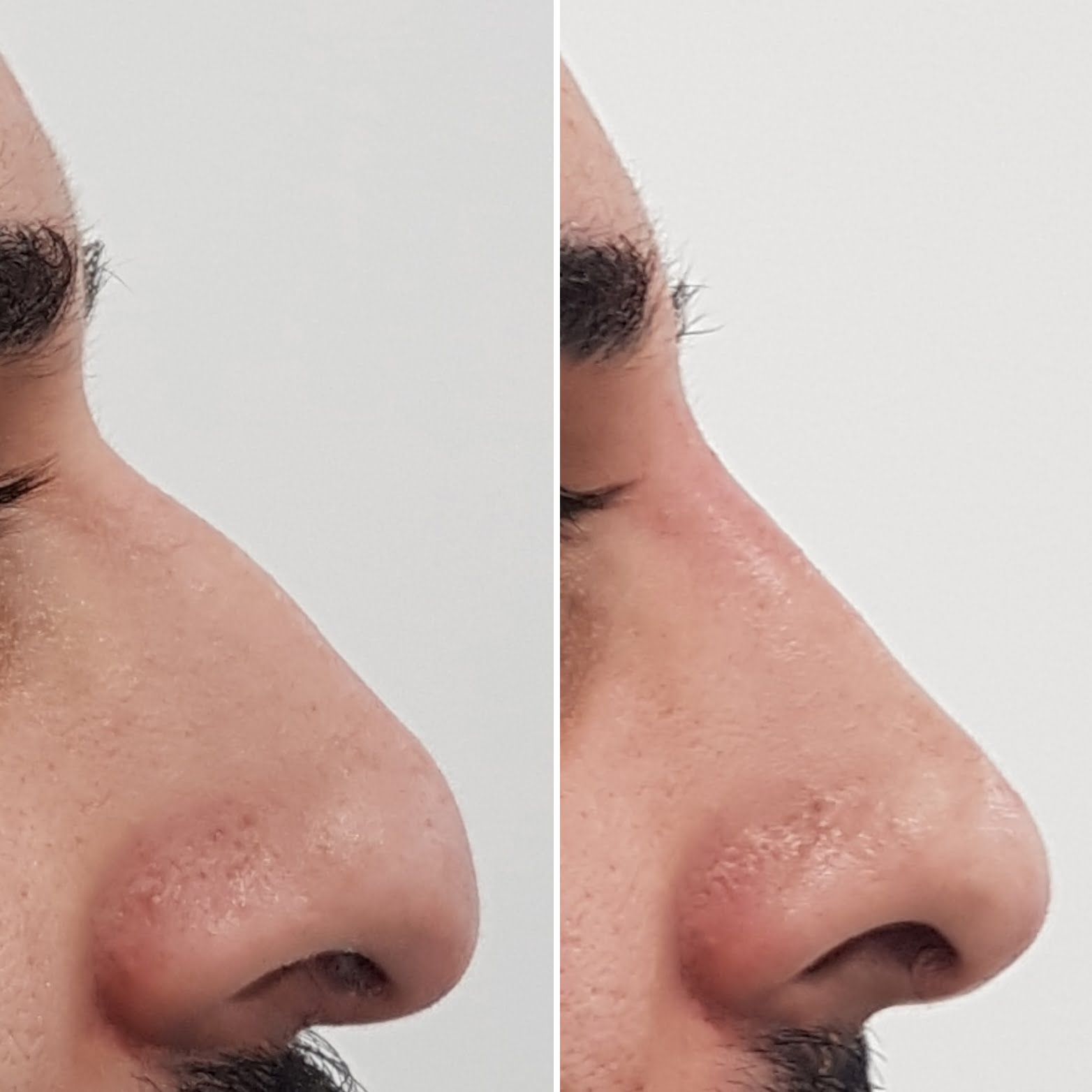 Mens Rhinoplasty before and after at our birmingham clinic