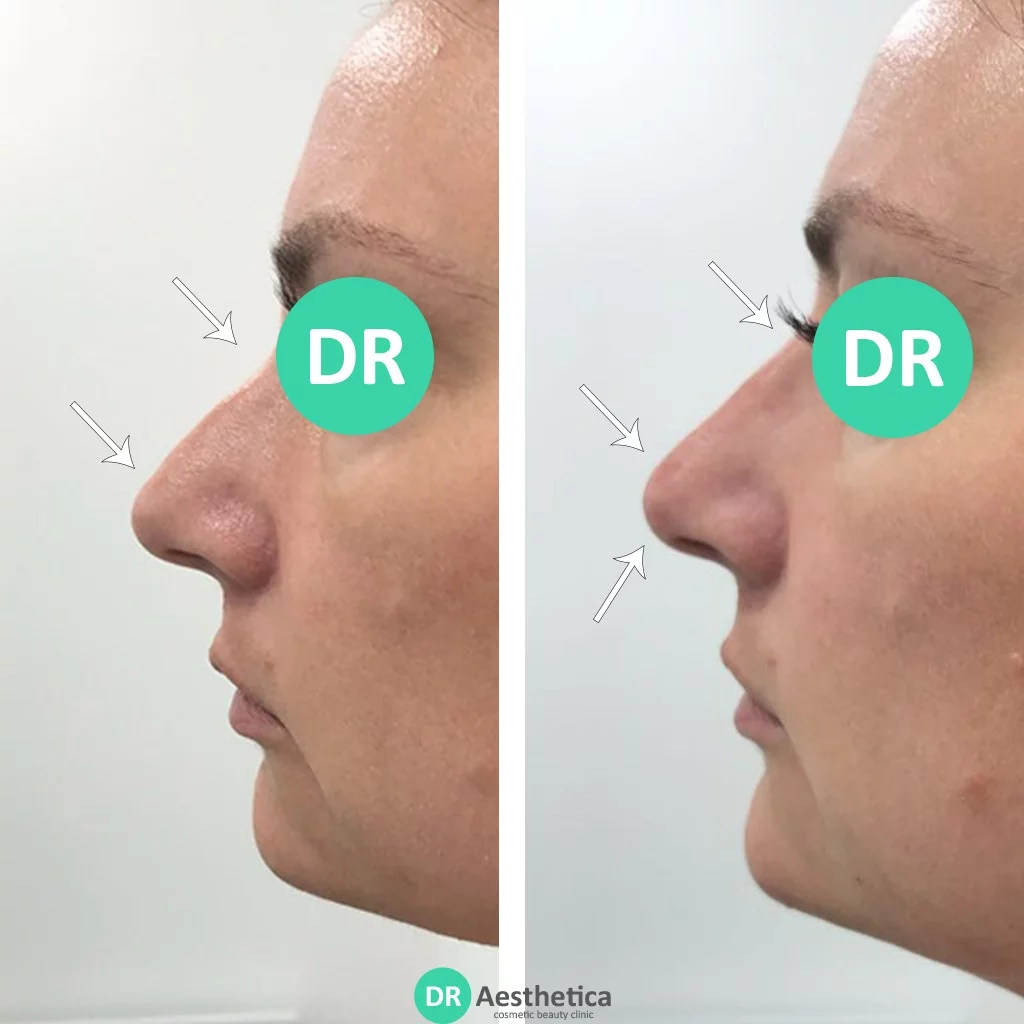 Bump on nose correction with dermal filler