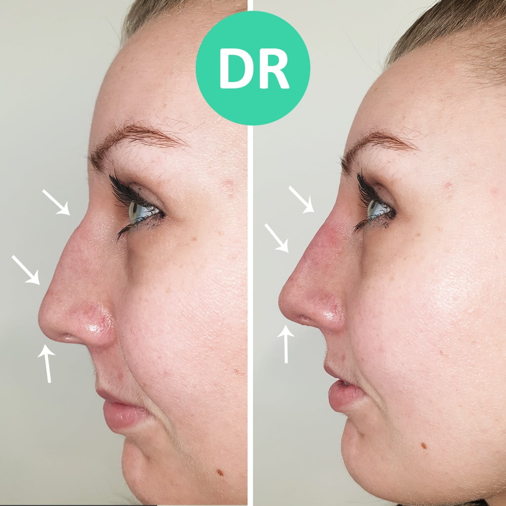 Treat Bump On Nose Treatment Without Surgery Dr Farmah