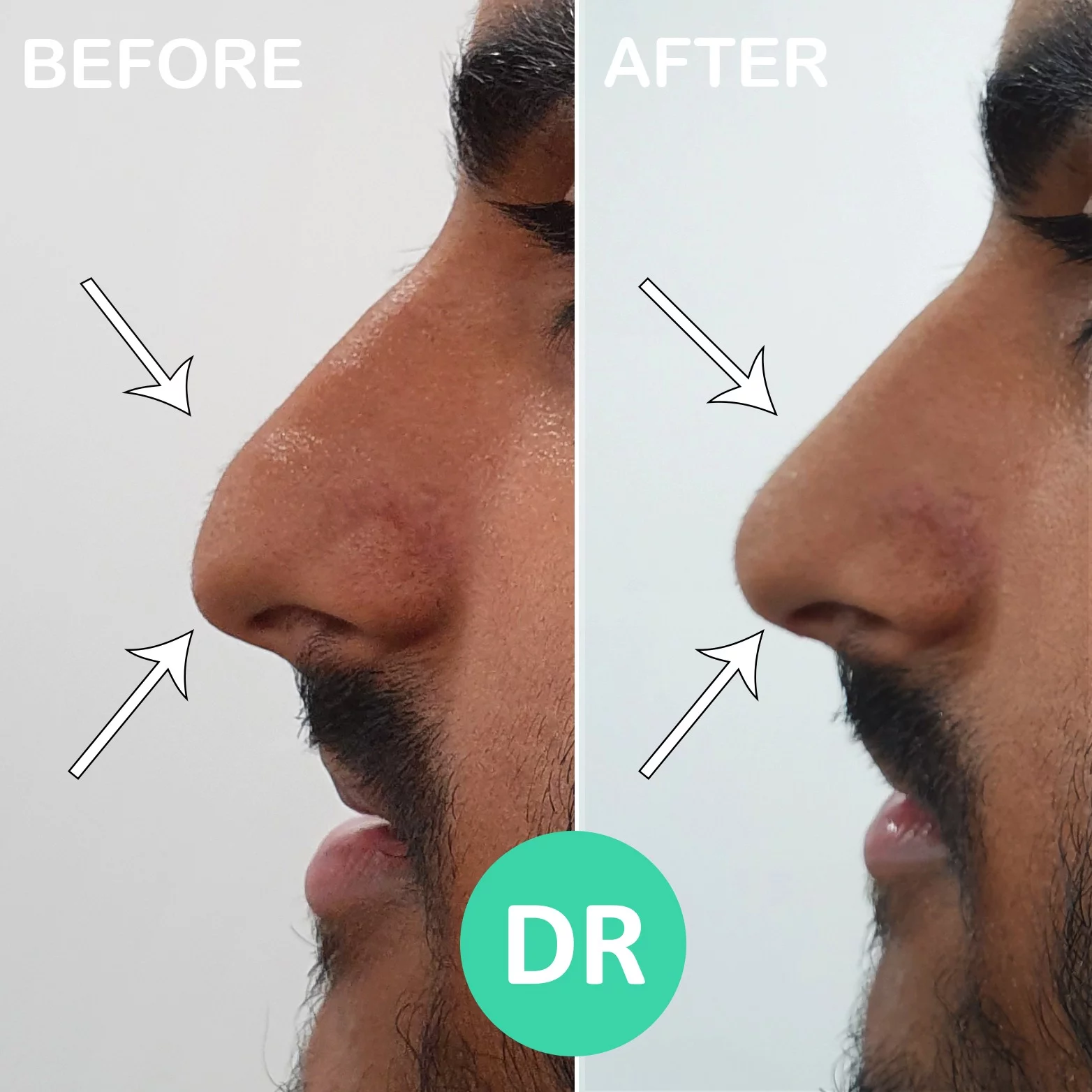 Non surgical rhinoplasty droopy tip