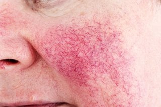 how to get rid of rosacea