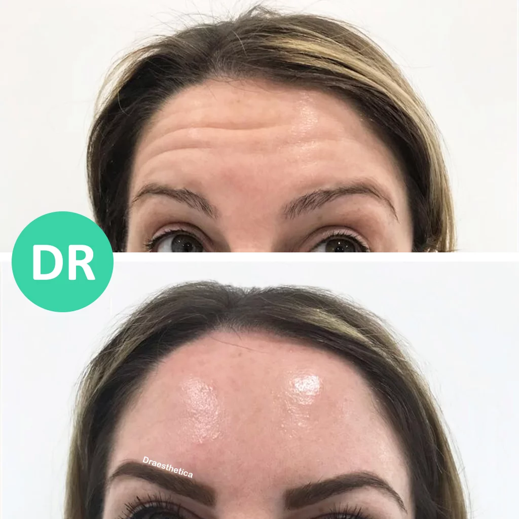 Forehead wrinkles botox before and after