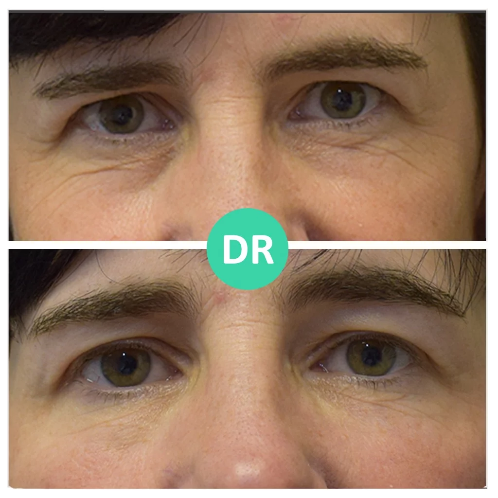 Static vs Dynamic Wrinkles How to Get Rid of Both Dr Aesthetica