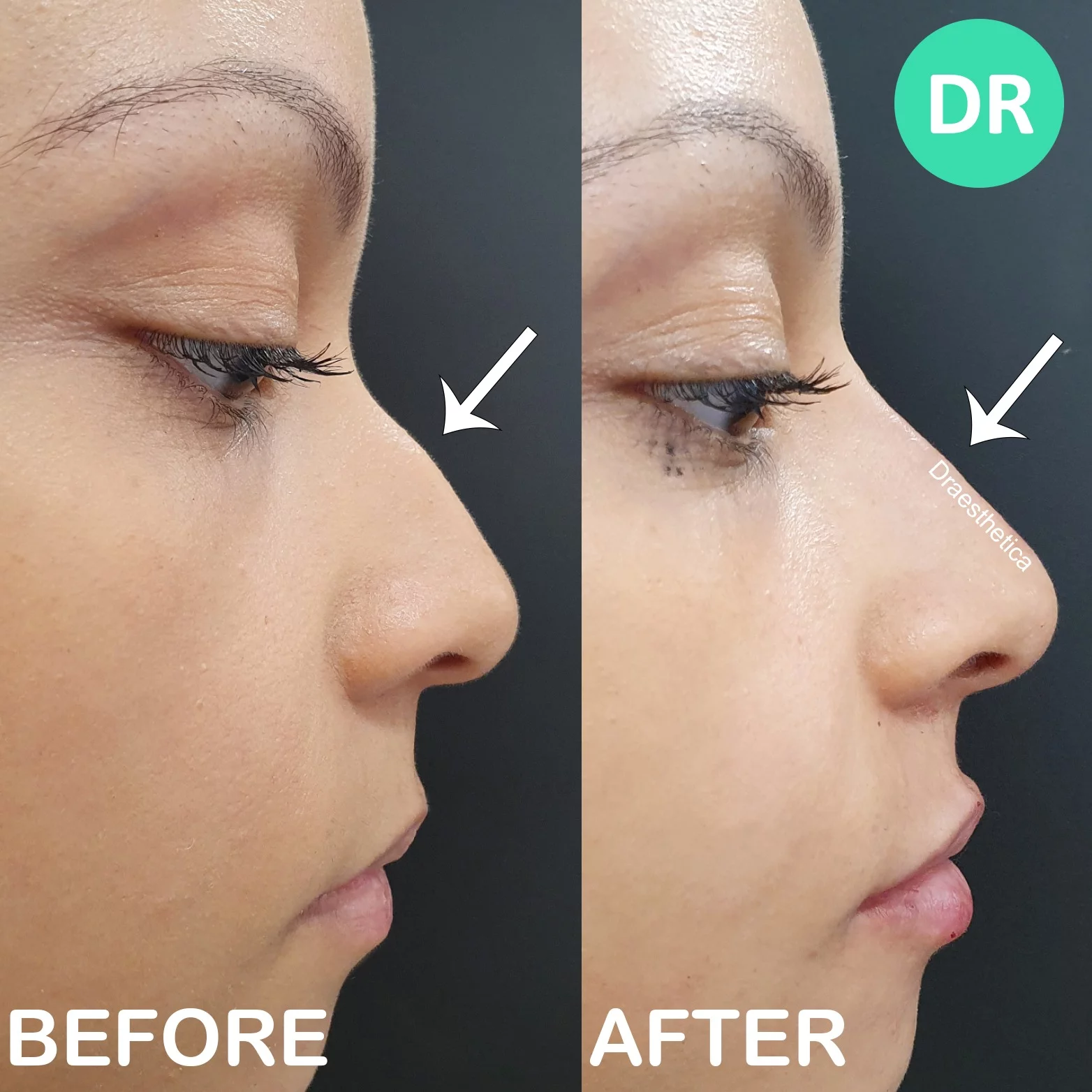 Droopy tip and hooked nose non surgical rhinoplasty