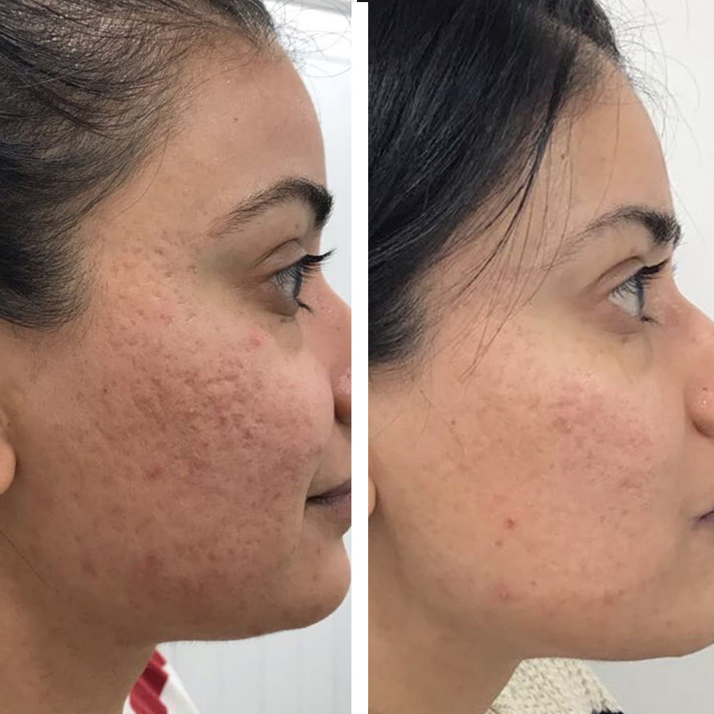 Microneedling 0320 Results 1