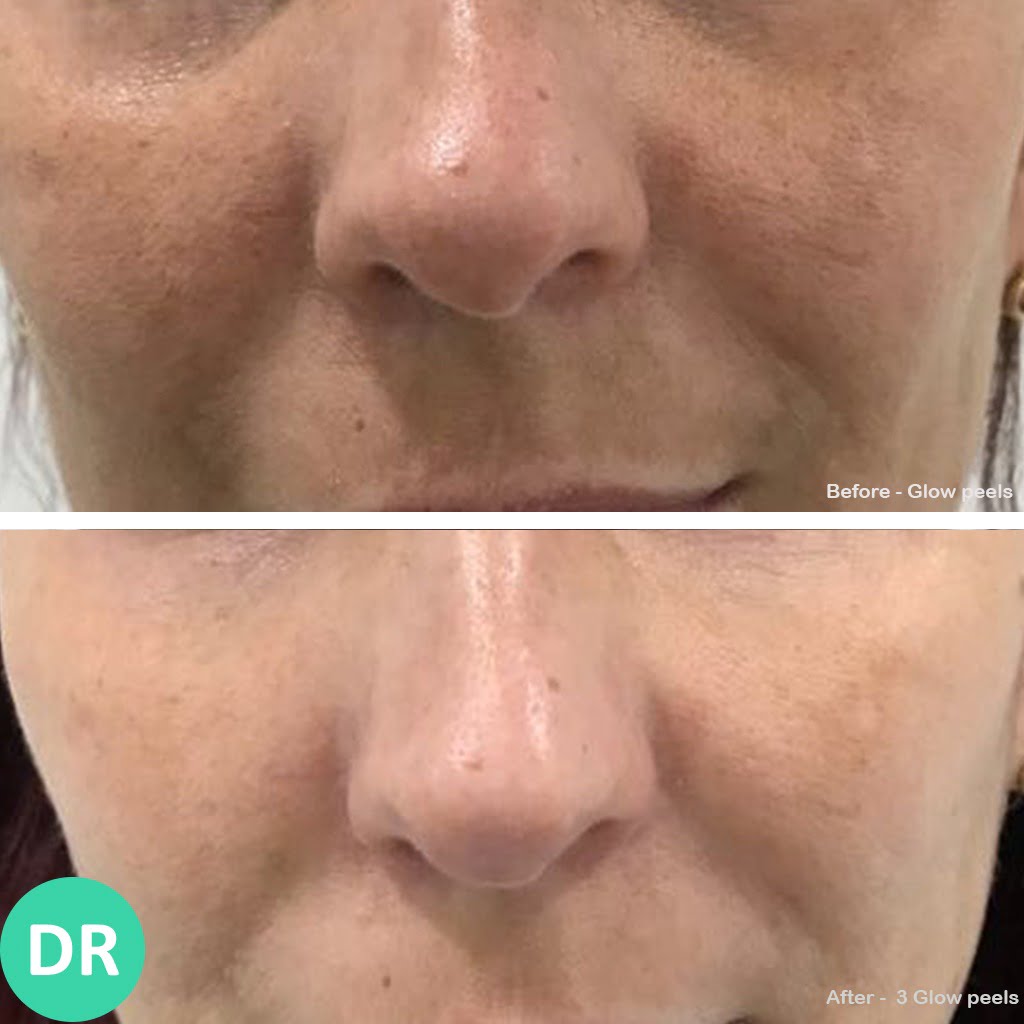Skin Peel Results 0320 5