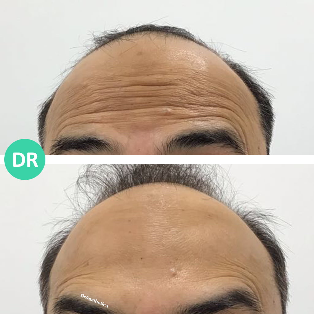 A male patient Before and aFter of forehead Botox at Dr Aesthetica's Birmingham Clinic