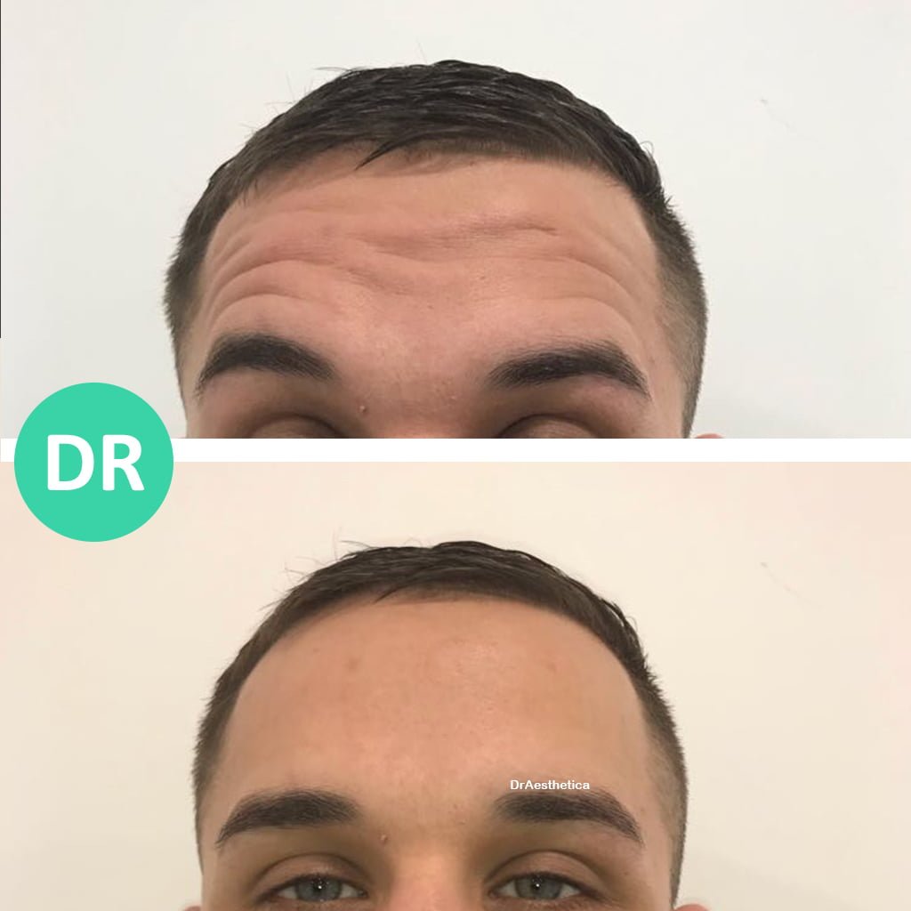 male forehead botox