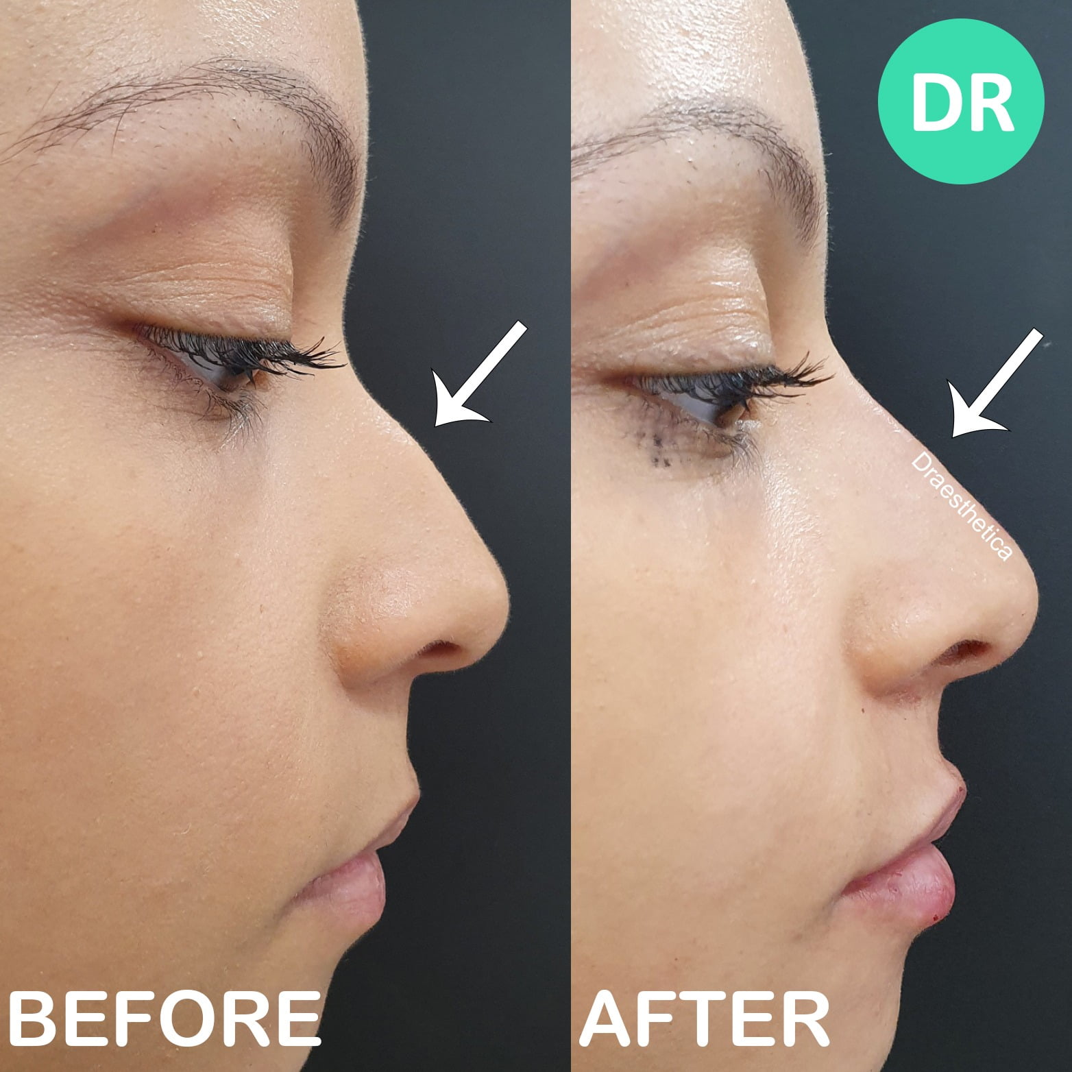 Non surgical rhinoplasty result at our birmingham clinic