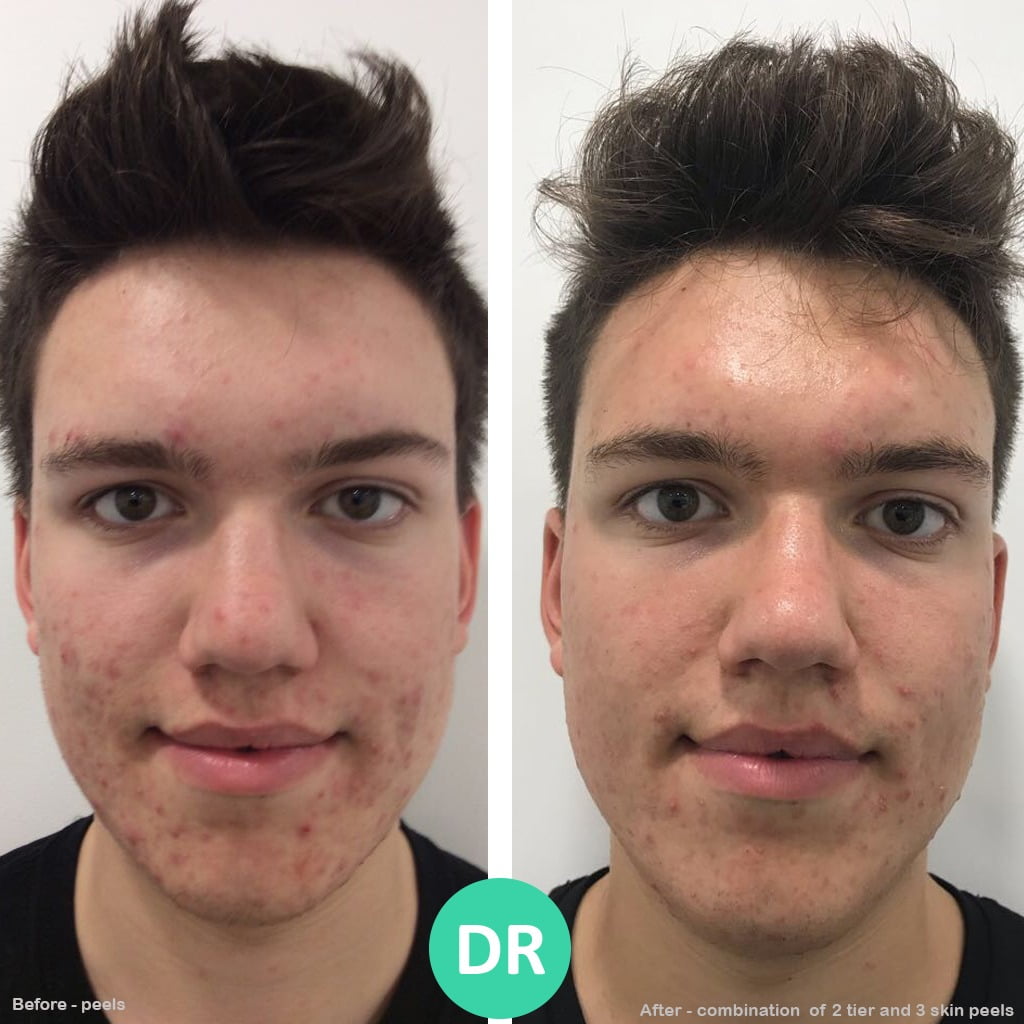 Before and after skin peel treatment at Dr. Aesthetica Birmingham showing brighter, smoother complexion.