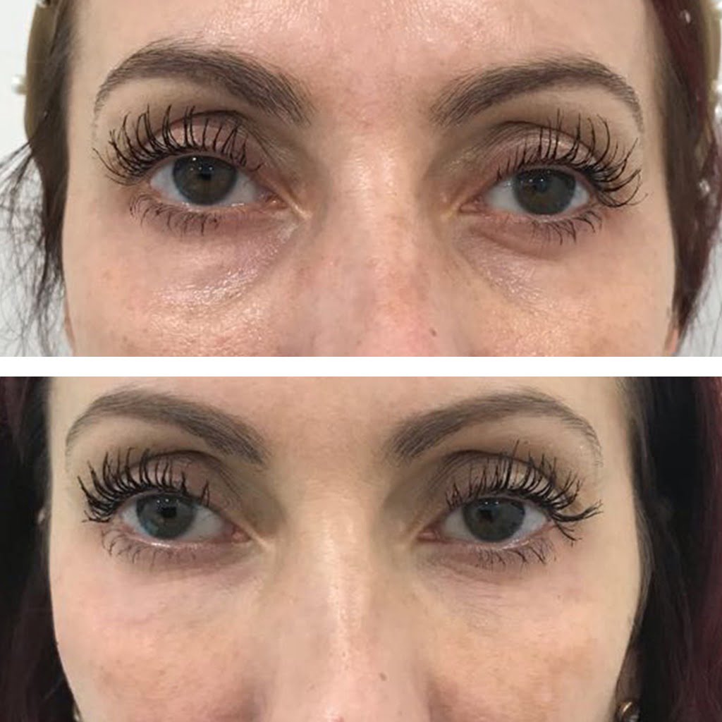 Everything to Know About Getting a Tear Trough Filler