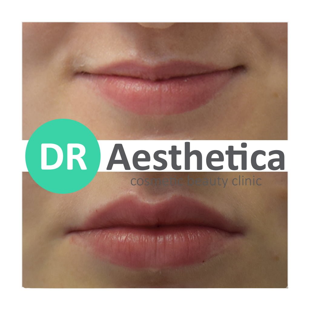 volume added through lip filler benefits