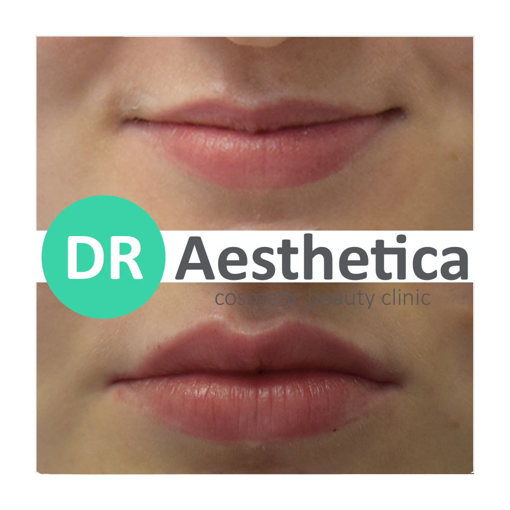Natural-looking lip filler results performed at Dr. Aesthetica Birmingham aesthetic clinic.