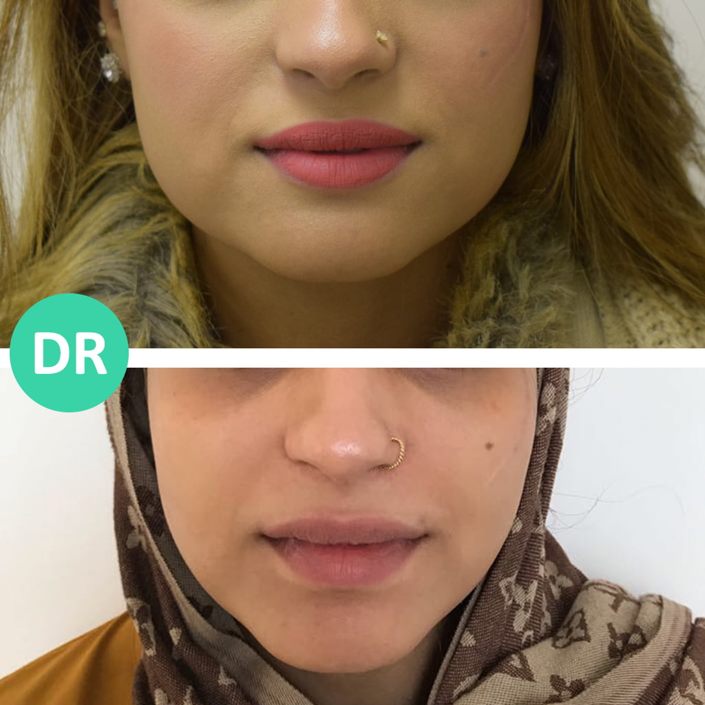 Dr Aesthetica Treating bruxism with botox giving jawline slimming as side effect
