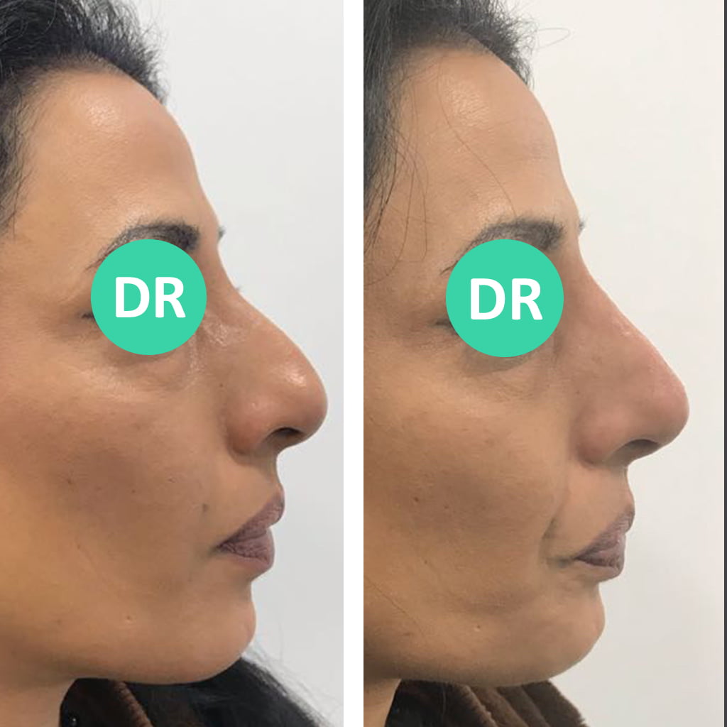 a patient in our birmingham clinic before and after receiving non surgical rhinoplasty