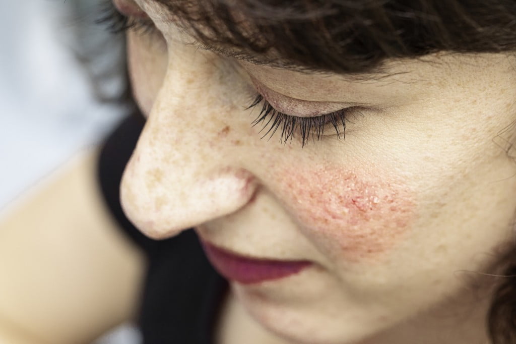 what is the main cause of rosacea