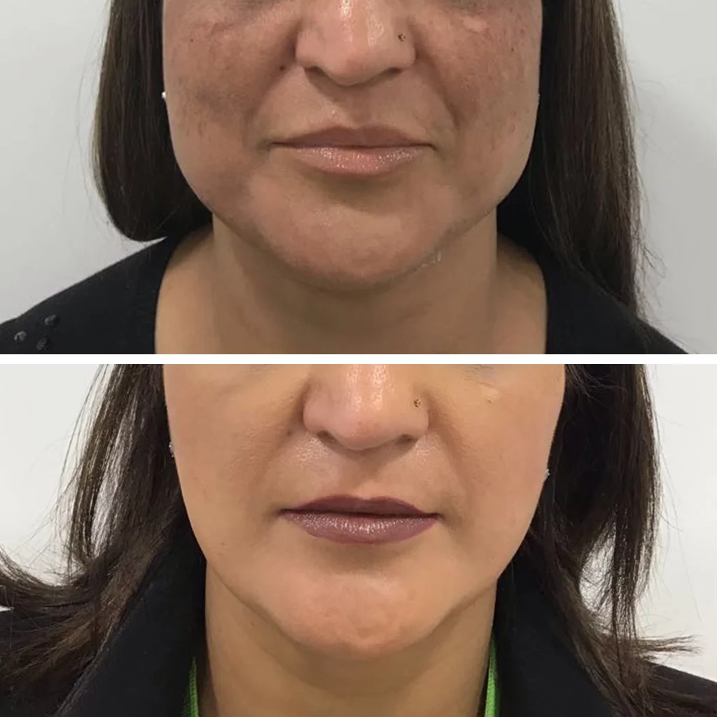 V shape Jawline with Botox use to slim Jaw and thin Face.
