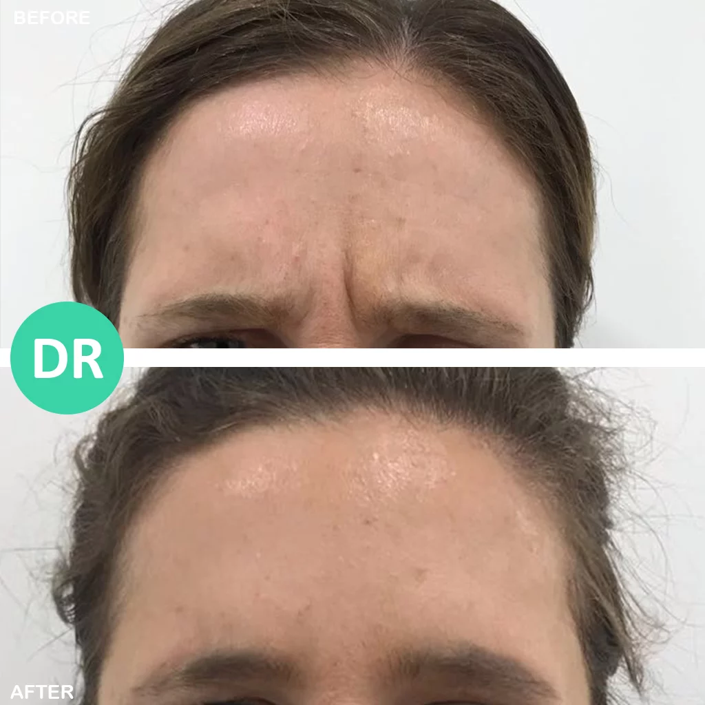 Frown Lines and Forehead Wrinkles: Prevention and Treatment