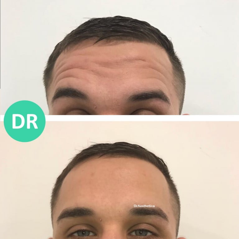 Wondering How to Get Rid of Forehead Lines?