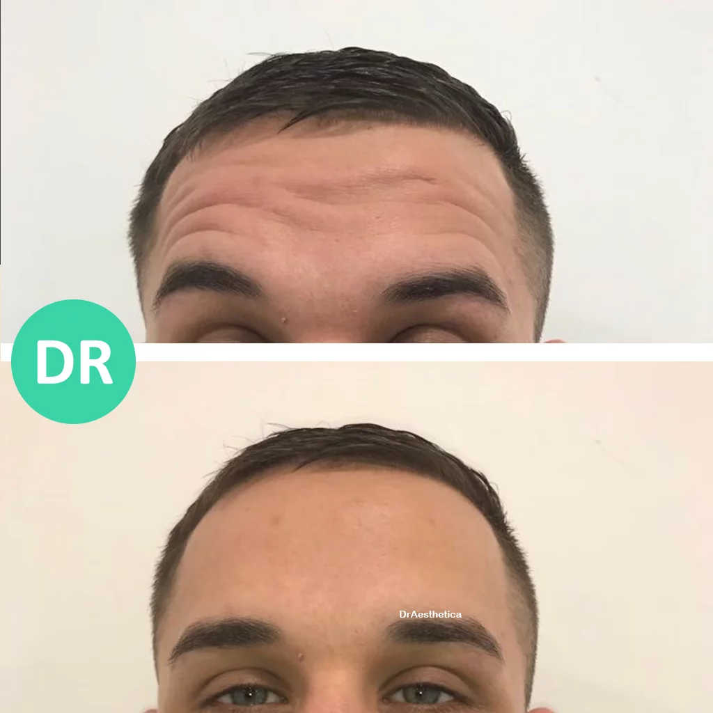 Static vs Dynamic Wrinkles How to Get Rid of Both Dr Aesthetica