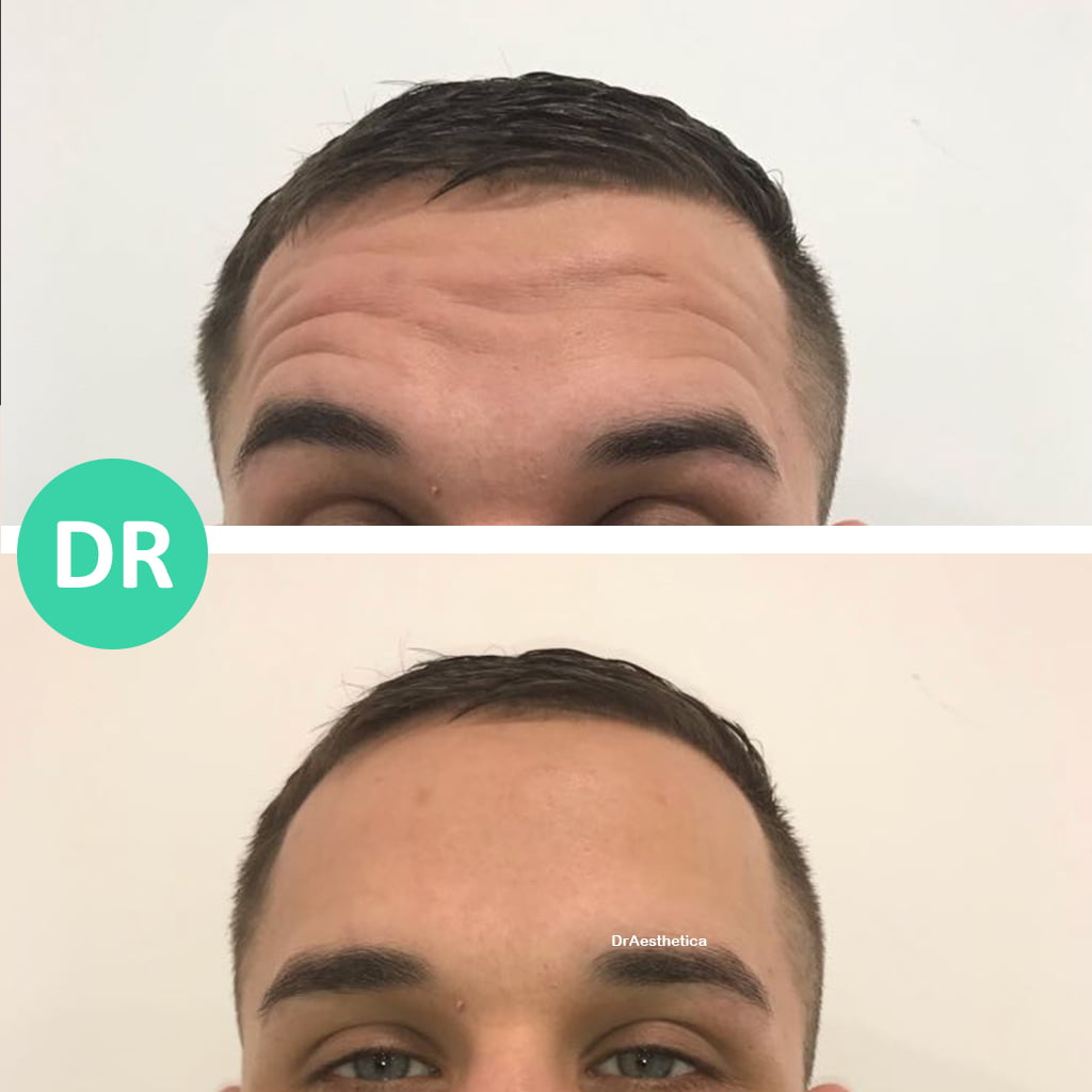 male forehead botox lines. Dynamic Wrinkles