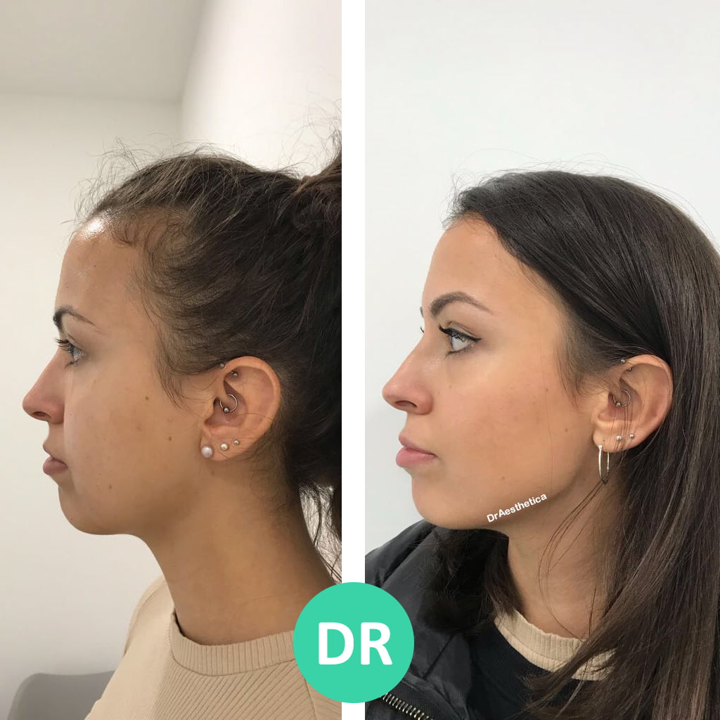 Jawline Slimming & Bruxism Treatment - Dr Aesthetica