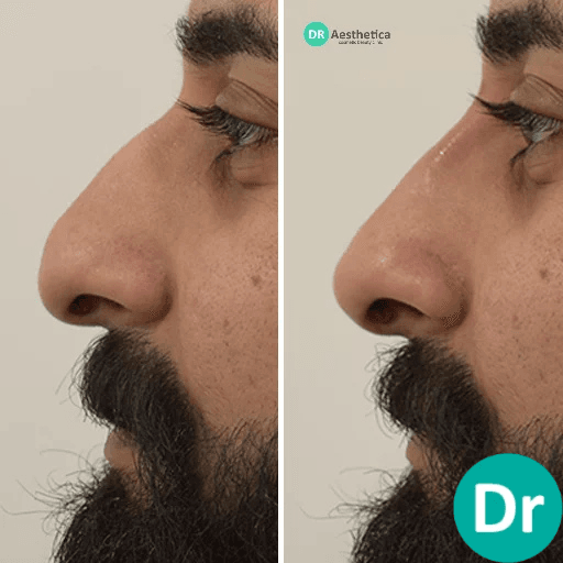 Dorsal Hump Nose before and after