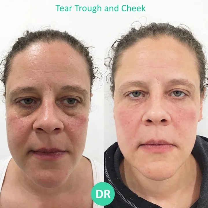 Tear trough and cheek filler before and after result