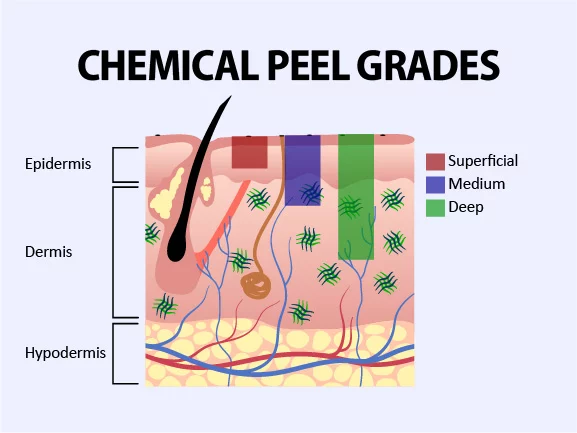 illustration of chemical peel depths