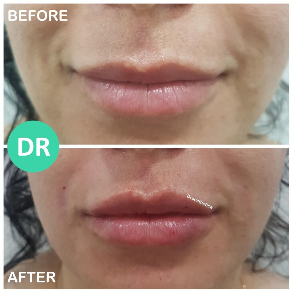 lip filler before and after