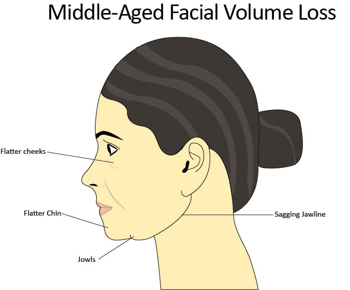 Profile depiction of middle-aged facial volume loss and common trouble areas: jowls, flattening cheeks, deepening nasolabial folds, and thinner lips