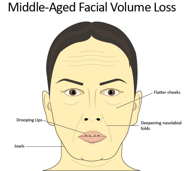 Depiction of middle-aged facial volume loss and common trouble areas: jowls, flattening cheeks, deepening nasolabial folds, and thinner lips.