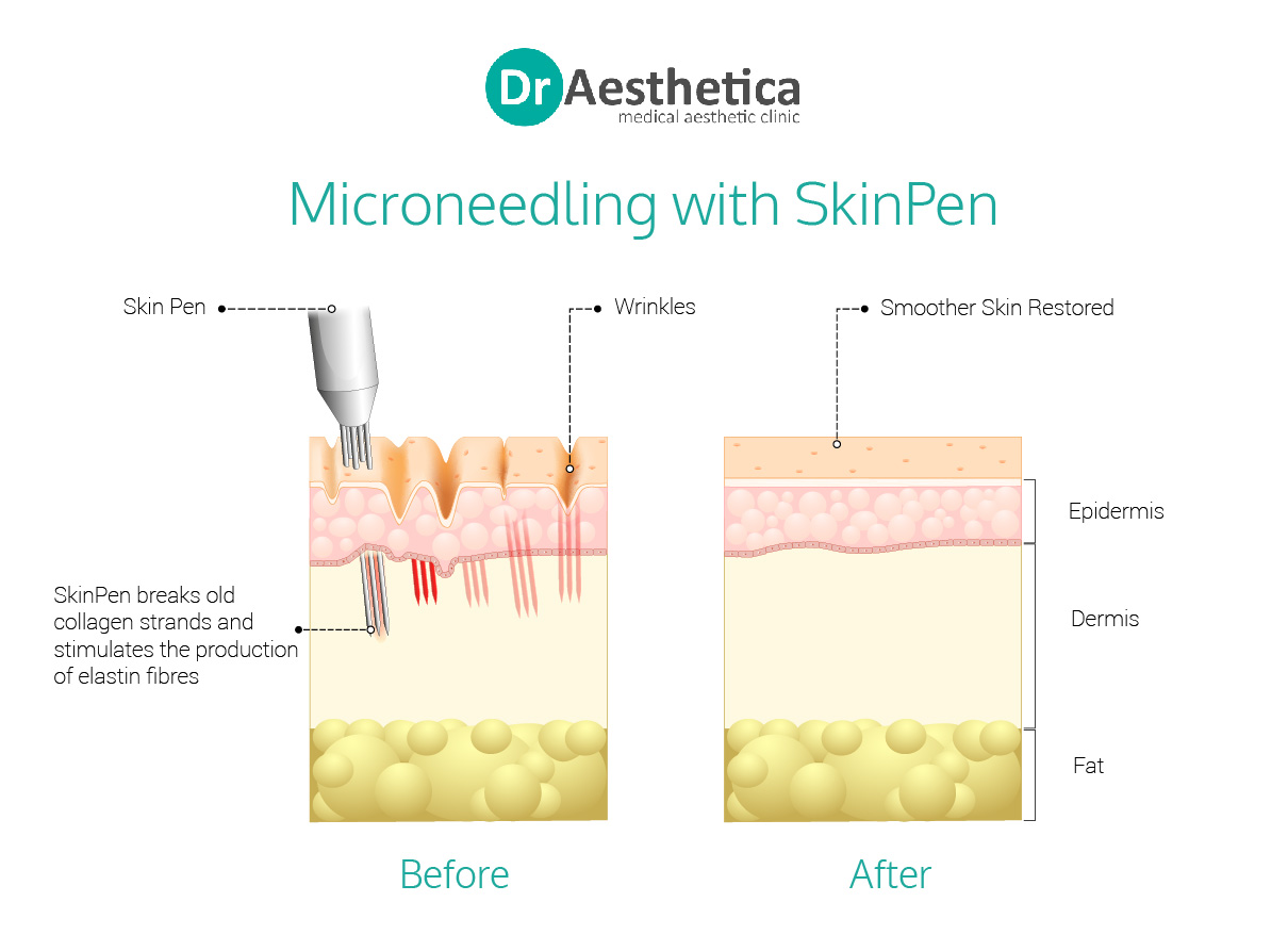 How Does Microneedling Work in 2021? (Benefits, Results and Costs) Dr