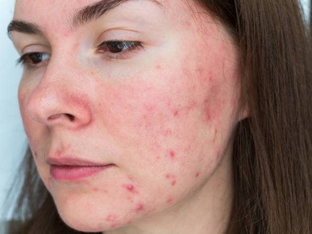 dermal filler allergic reactions