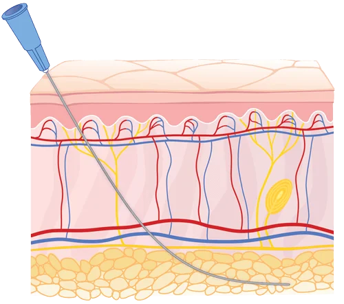 Cannula technique