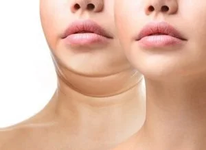 Top Non-Surgical Options For Getting Rid of a Double Chin