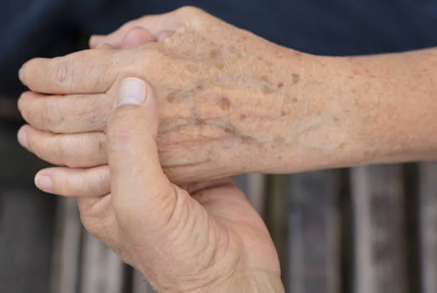 Age-spots-hand-ageing-effect