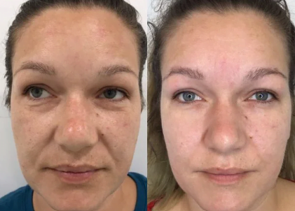 microneedling before and after