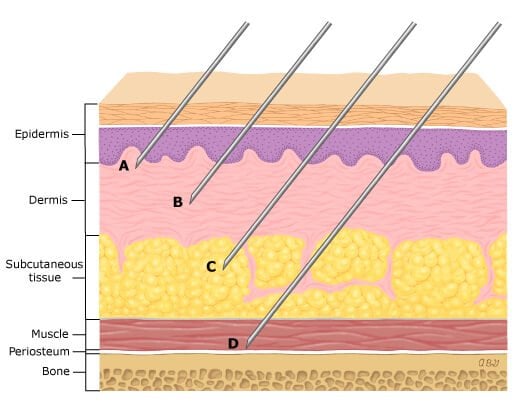 Common Techniques Used to Inject Fillers into Your Face - Dr Aesthetica