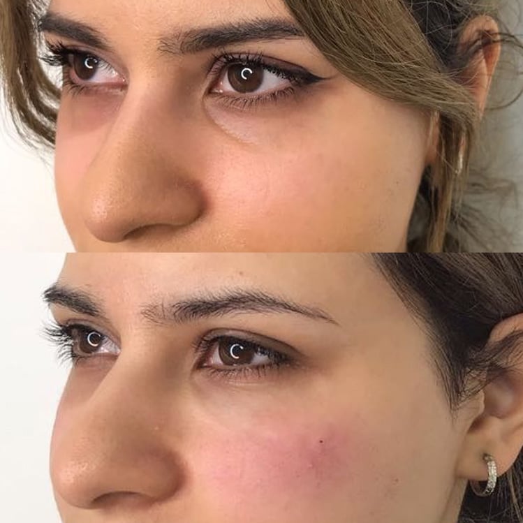 How to Get Rid of Dark UnderEye Circles For Good