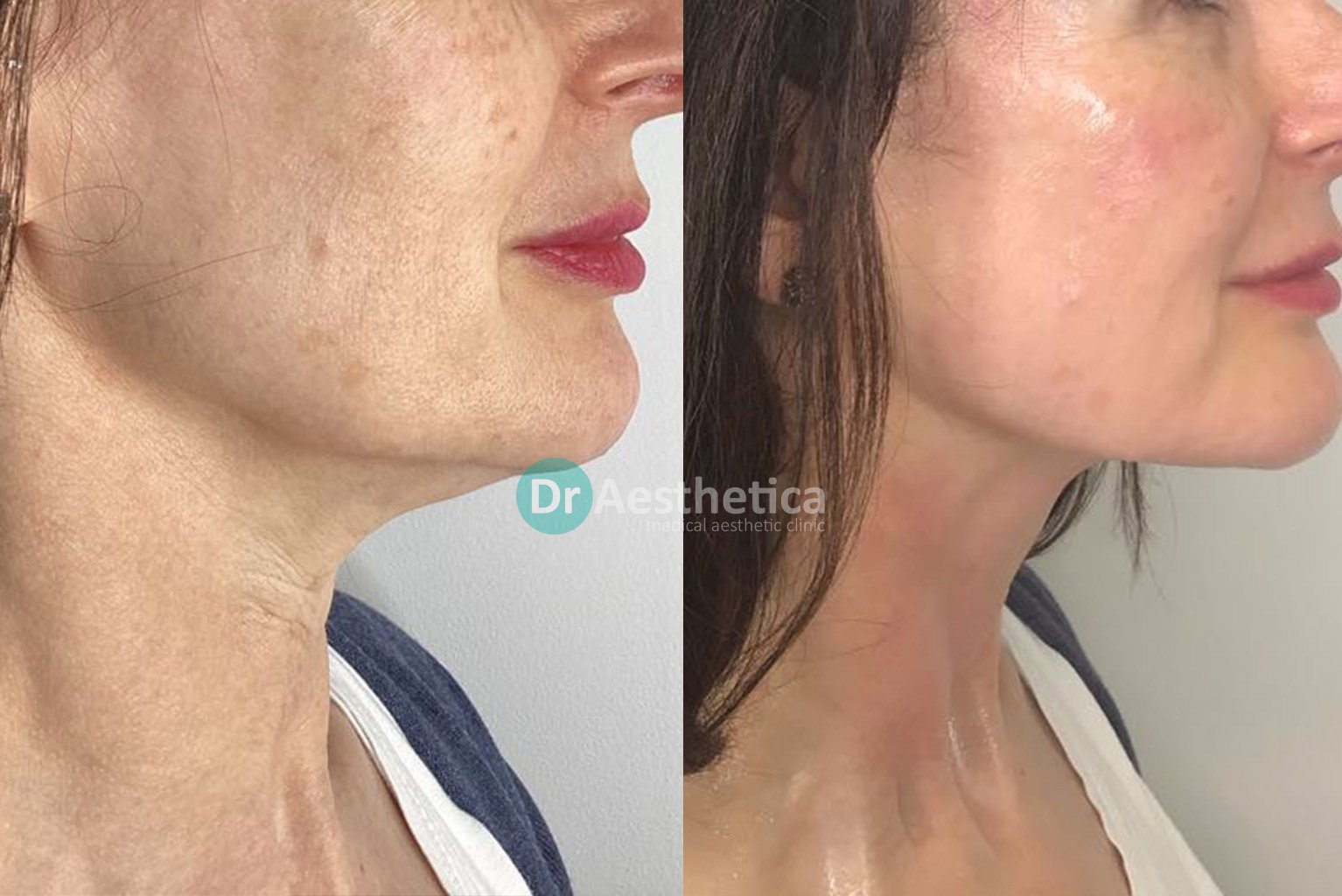 Botox For Jowls Non Surgical Jowl Lift Dr Aesthetica 