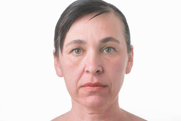 Menopause facial changes