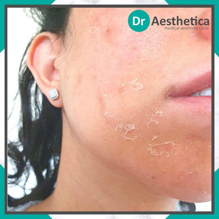 Post-Inflammatory Erythema: What It Is and How to Treat It - Dr Aesthetica