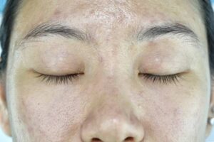 how do acne scars form