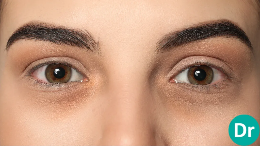Under Eye Filler Treatment